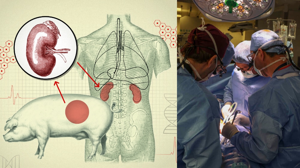 First Pig-Kidney Transplant Offers New Hope for Organ Recipients.